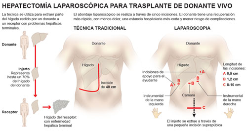Infográfico sobre el trasplante de hígado por laparoscopia