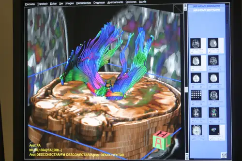 Diagnostico radiologico en el ictus Imagen de prueba diagnóstica en pacientes que han sufrido un ictus
