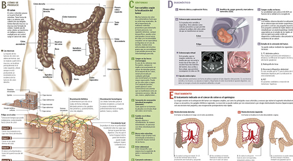 Cáncer de colon Imagen preview del infográfico sobre cáncer de colon