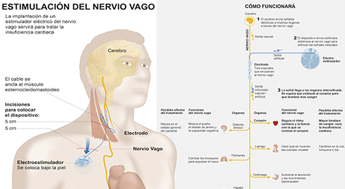 Infográfico estimulación del nervio vago Técnicas de estimulación del nervio vago para solucionar la insuficiencia cardiaca