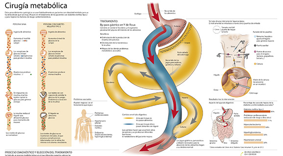 Imagen preview Cirugía metabólica Imagen preview del infográfico sobre cirugía metabólica