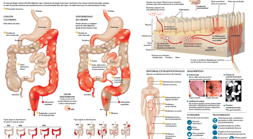 Imagen preview infografico enfermedad inflamatoria intestinal Imagen preview del infográfico sobre la enfermedad inflamatoria intestinal
