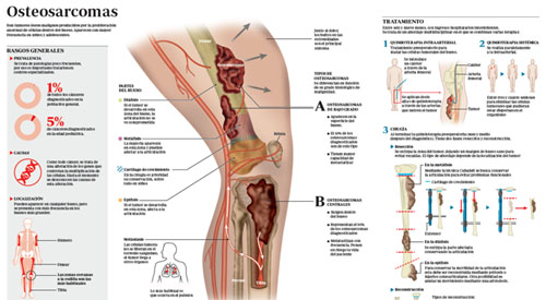 Infográfico sobre los osteosarcomas Imagen preview infográfico sobre los osteosarcomas
