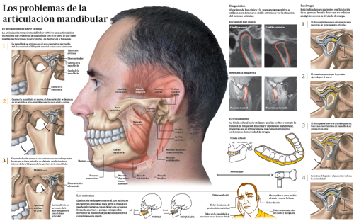 Imagen infográfico problemas articulación temporomandibular Imagen preview del infográfico sobre la articulación temporomandibular