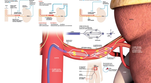 Imagen preview del infográfico Denervación renal para la hipertensión arterial Imagen preview del infográfico Denervación renal para la hipertensión arterial