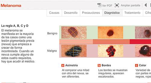 img-animacion-melanoma