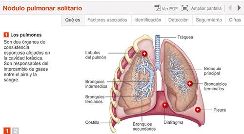 img-animacion-nodulo-pulmonar
