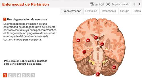 img-animacion-enfermedad-parkinson