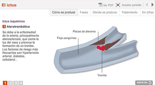 img-animacion-ictus