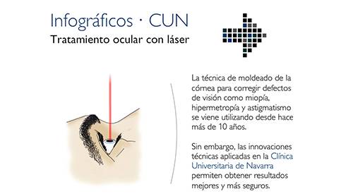 img-animacion-laser-ocular