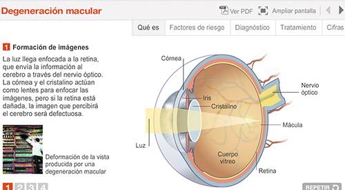img-preview-animacion-degeneracion-macular