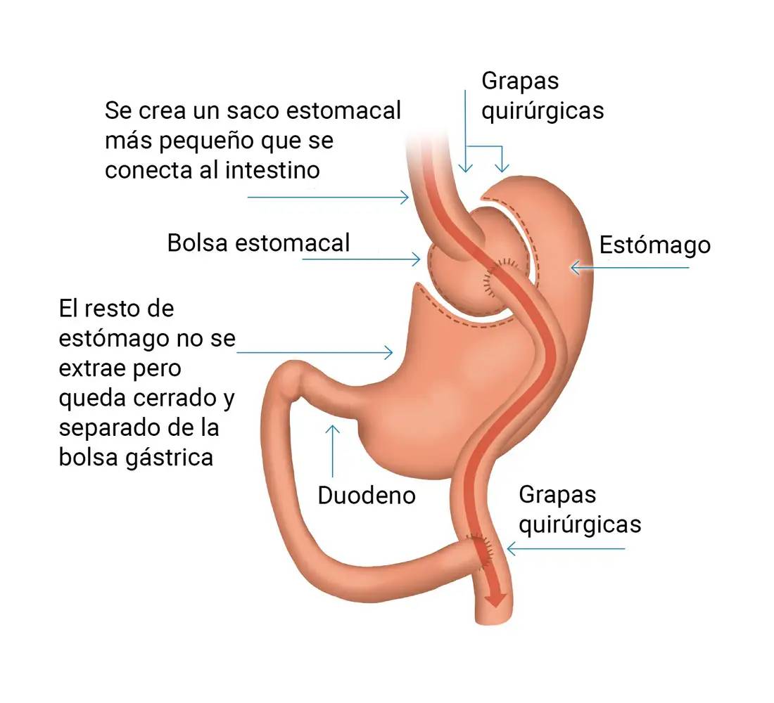by-pass-gastrico-laparoscopico