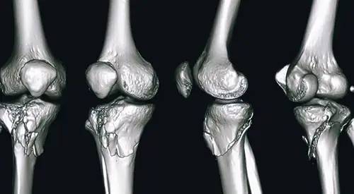 Fracturas De Tibia Proximal Sintomas Y Tratamiento Cun