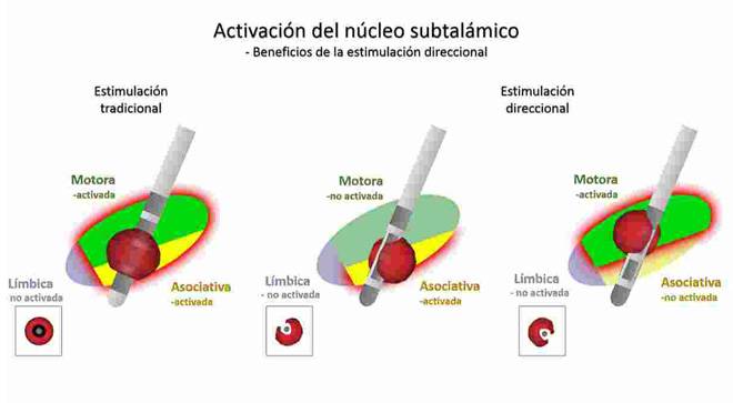 ensayo-clinico-estimulacion-direccional-control-impulsos Imagen gráfica de la estimulación dirección, una técnica empleada en un ensayo clínico de la Clínica Universidad de Navarra.