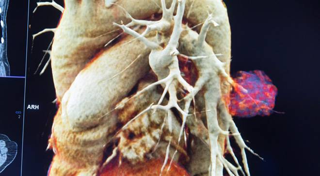 imagen-cancer-pulmon Imagen en 3D de un cáncer de pulmón diagnosticado en la Clínica Universidad de Navarra.