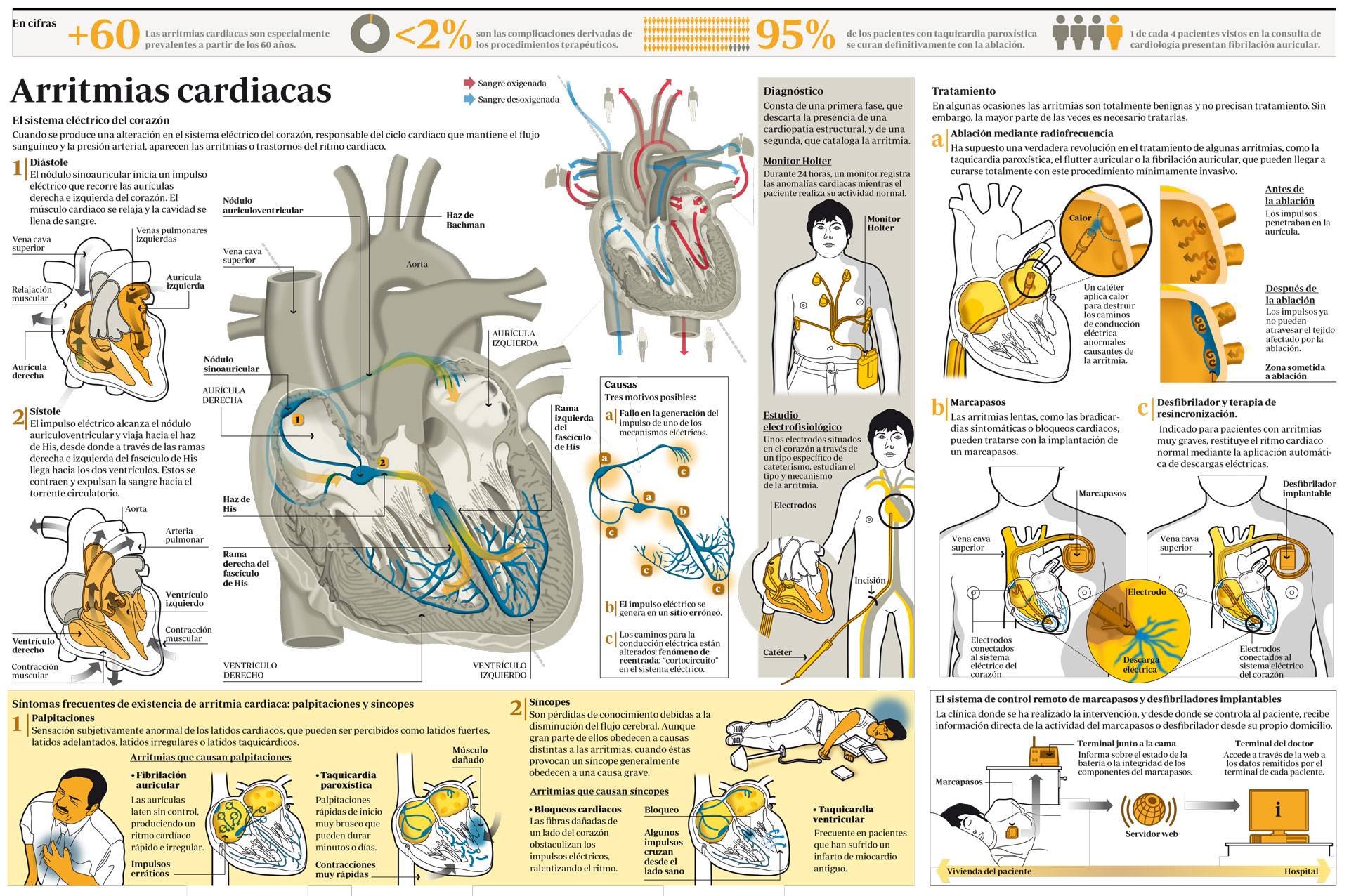 Ablacion cardiaca como se hace