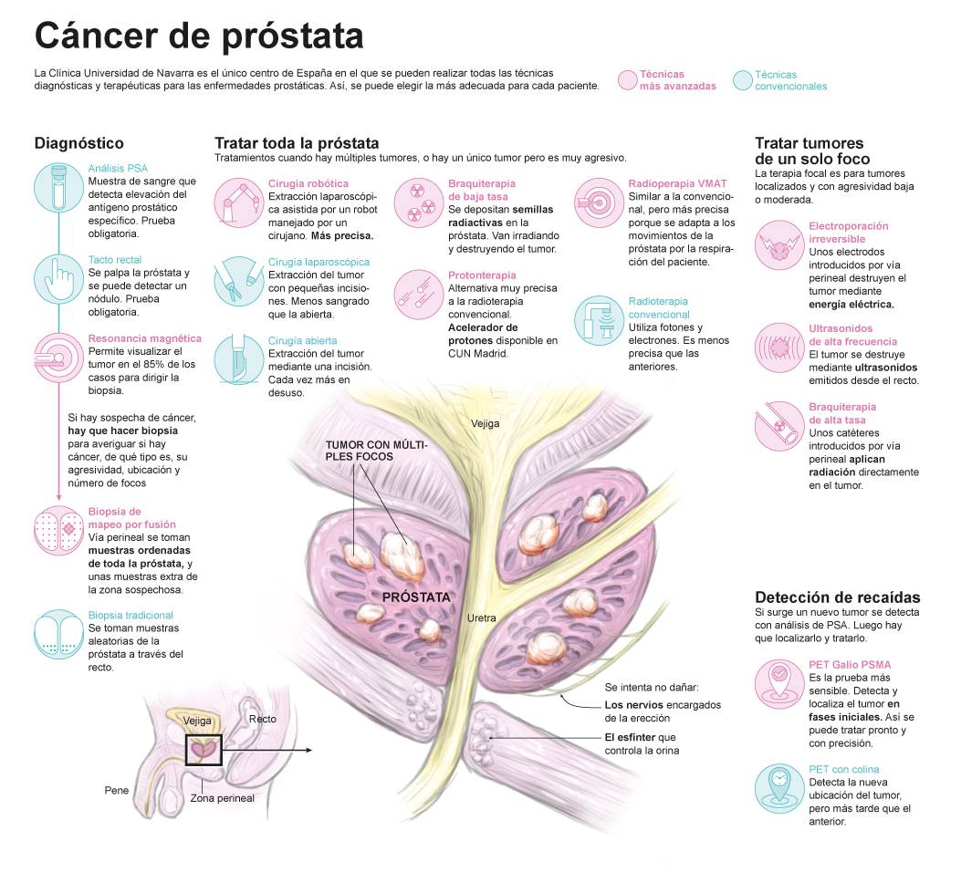 diagnóstico diferencial de cáncer de próstata