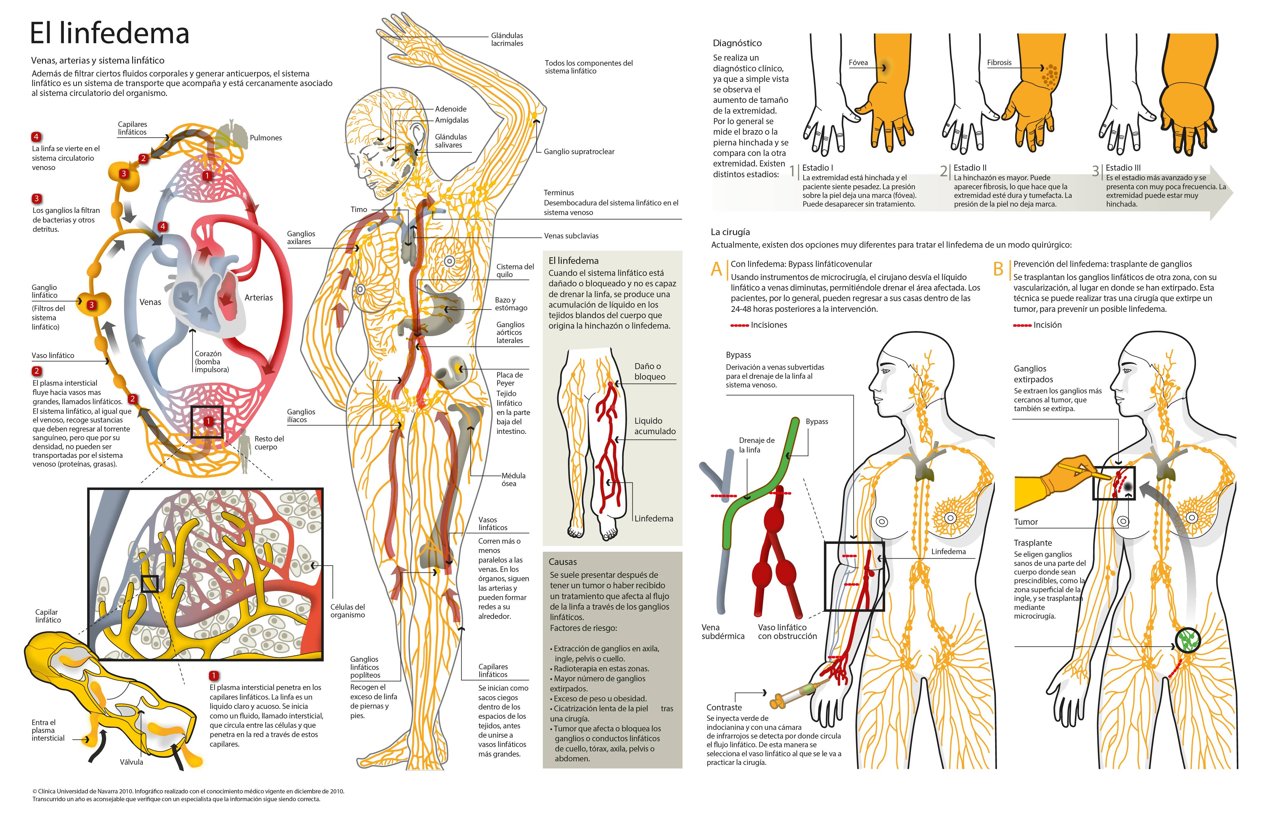 2010-linfedema-max <p>Infográfico sobre el linfedema, qué es y su tratamiento. Clínica Universidad de Navarra </p>