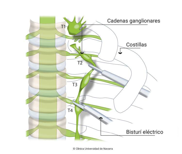 simpatectomia-toracica-endoscopica-cirugia-hiperhidrosis Cirugía mínimamente invasiva vía endoscópica con resultados son inmediatos para solucionar la hiperhidrosis. Clínica Universidad de Navarra