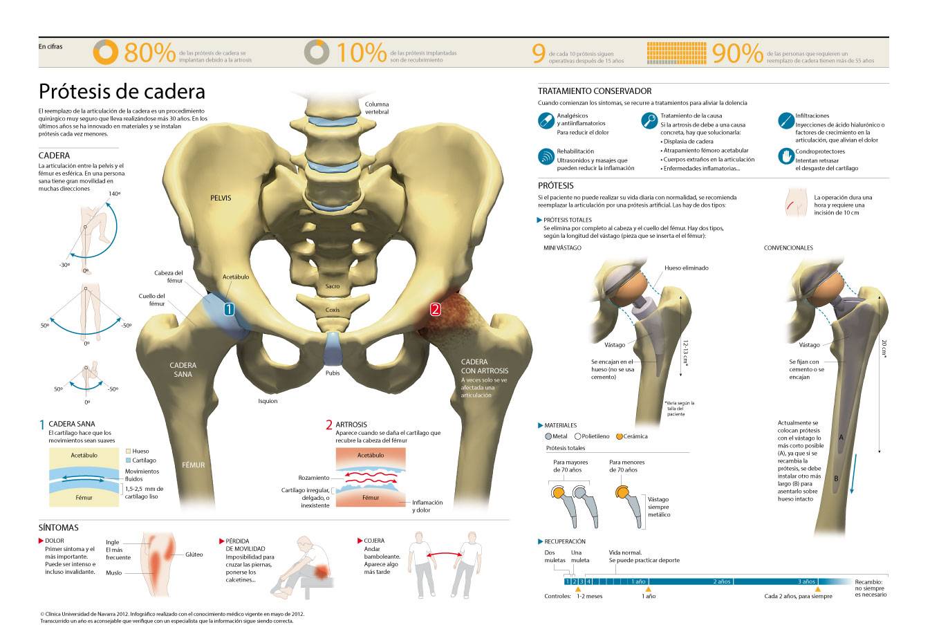 <p>Infogr&aacute;fico sobre la pr&oacute;tesis de cadera, sustituci&oacute;n de la cadera en casos de artrosis y otras enfermedades degenerativas de la cadera.&nbsp;</p>
