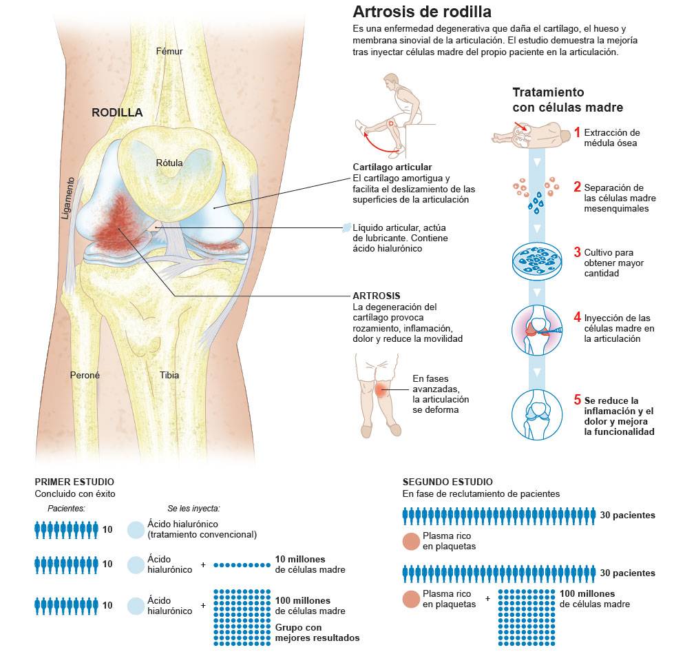 Artrosis. Síntomas, diagnóstico y tratamiento. Clínica U. Navarra