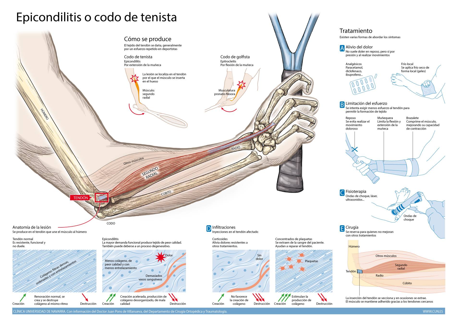 <p>Imagen de la infografía sobre la epicondilitis o codo de tenista, realizada por la Clínica Universidad de Navarra</p>