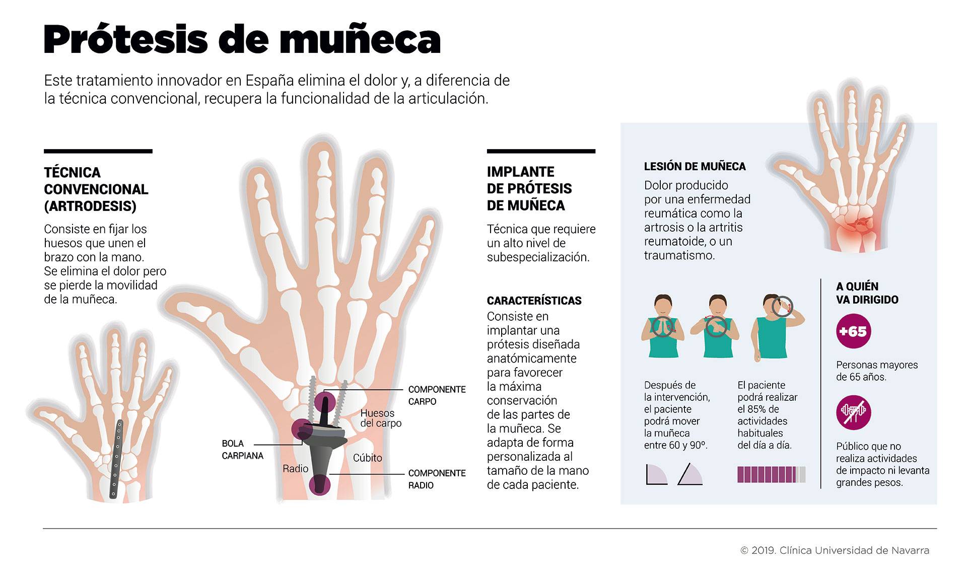 incluir caligrafía árbitro Artrosis de la mano y muñeca: síntomas y tratamiento. Clínica Universidad  de Navarra