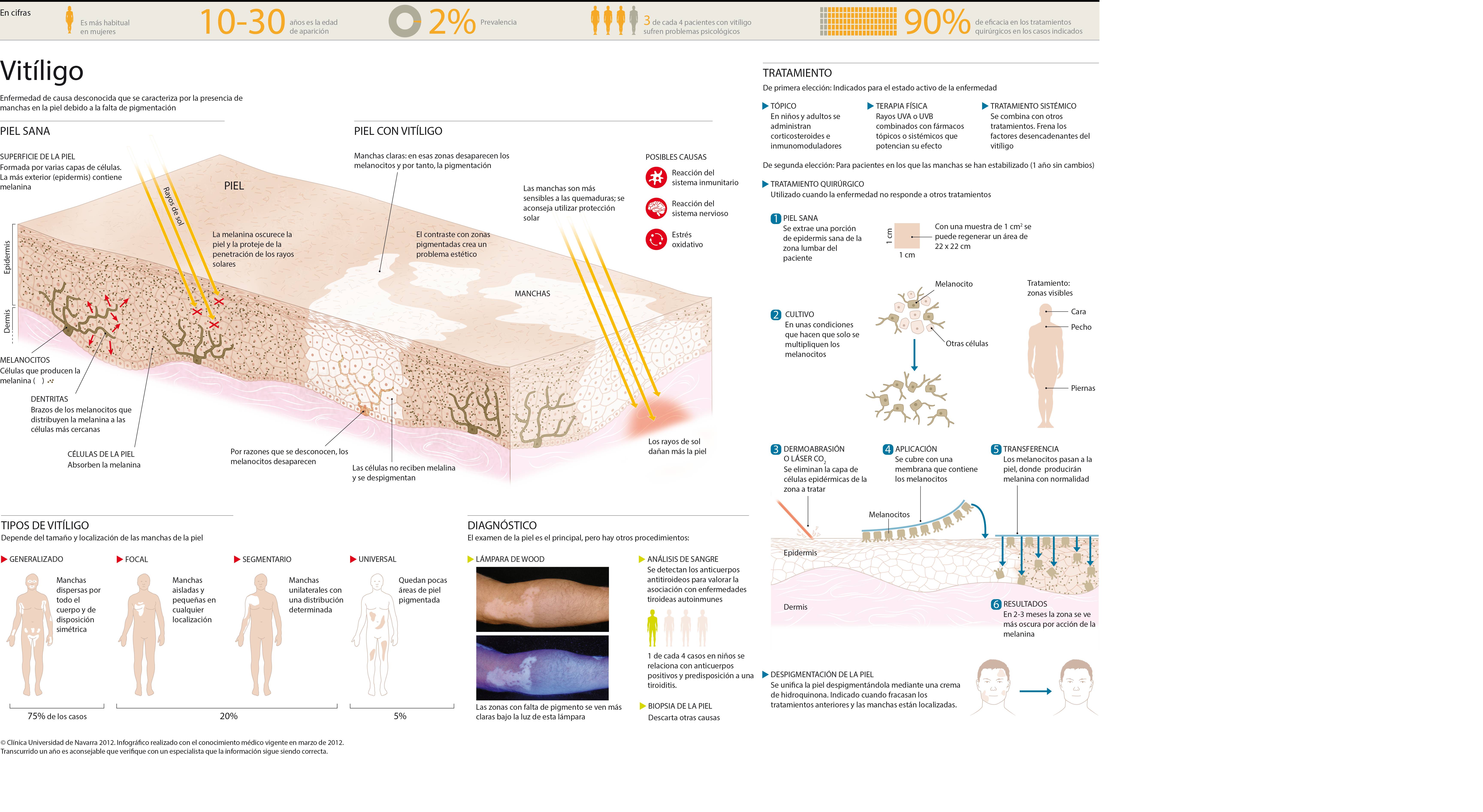 2012-vitiligo-max <p>Infografía del vitíligo, enfermedad que despigmenta la piel y causa manchas blancas</p>