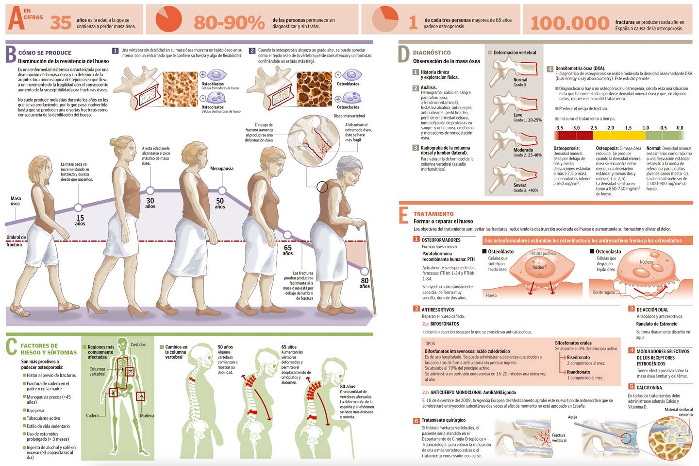 Osteoporosis. Infografía. Clínica Universidad de Navarra