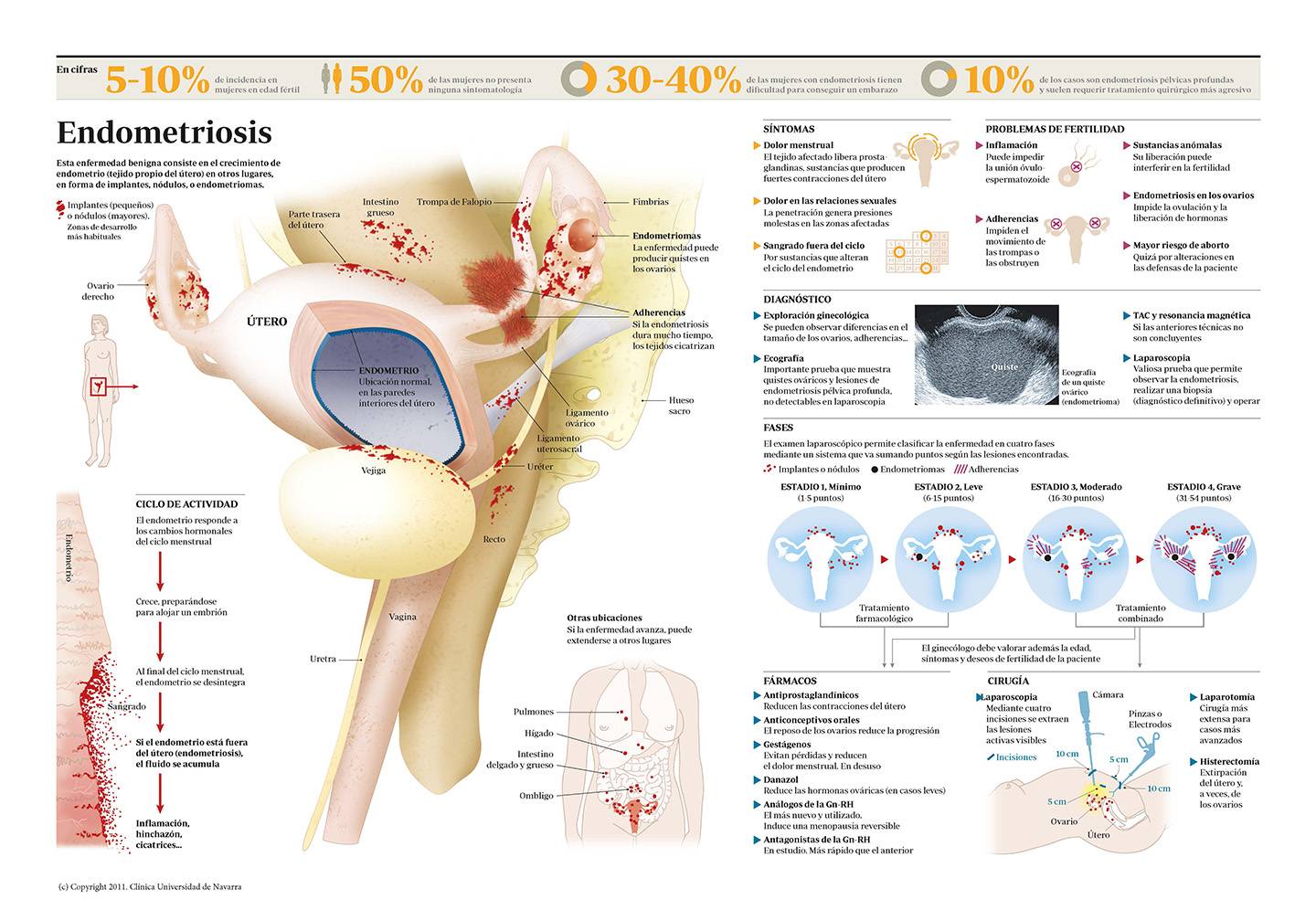 Infografía endometriosis. Clínica Universidad de Navarra Infografía sobre la endometriosis. Conozca todo sobre esta enfermedad. Clínica Universidad de Navarra