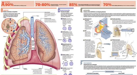 Nódulo pulmonar Imagen preview del infográfico sobre el nódulo pulmonar