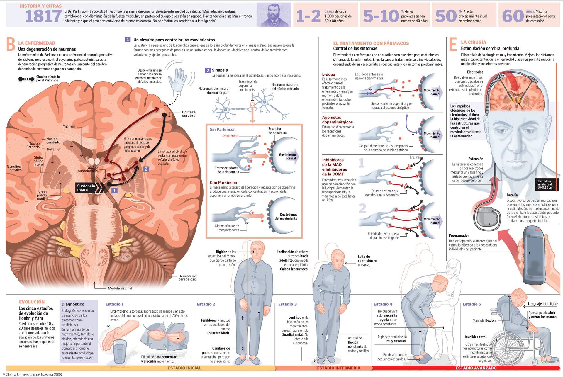 Enfermedad de Parkinson Síntomas, diagnóstico y tratamiento. Clínica