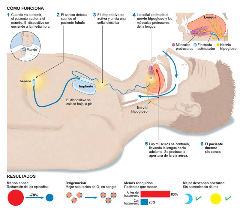 infografico-max-apnea-estimulacion-nervio-hipogloso