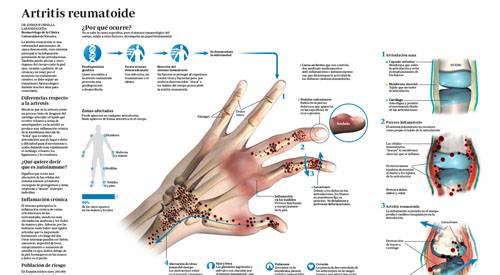 Artrosis de rodilla. Qué es, síntomas, diagnóstico y tratamiento. Clínica  Universidad de Navarra