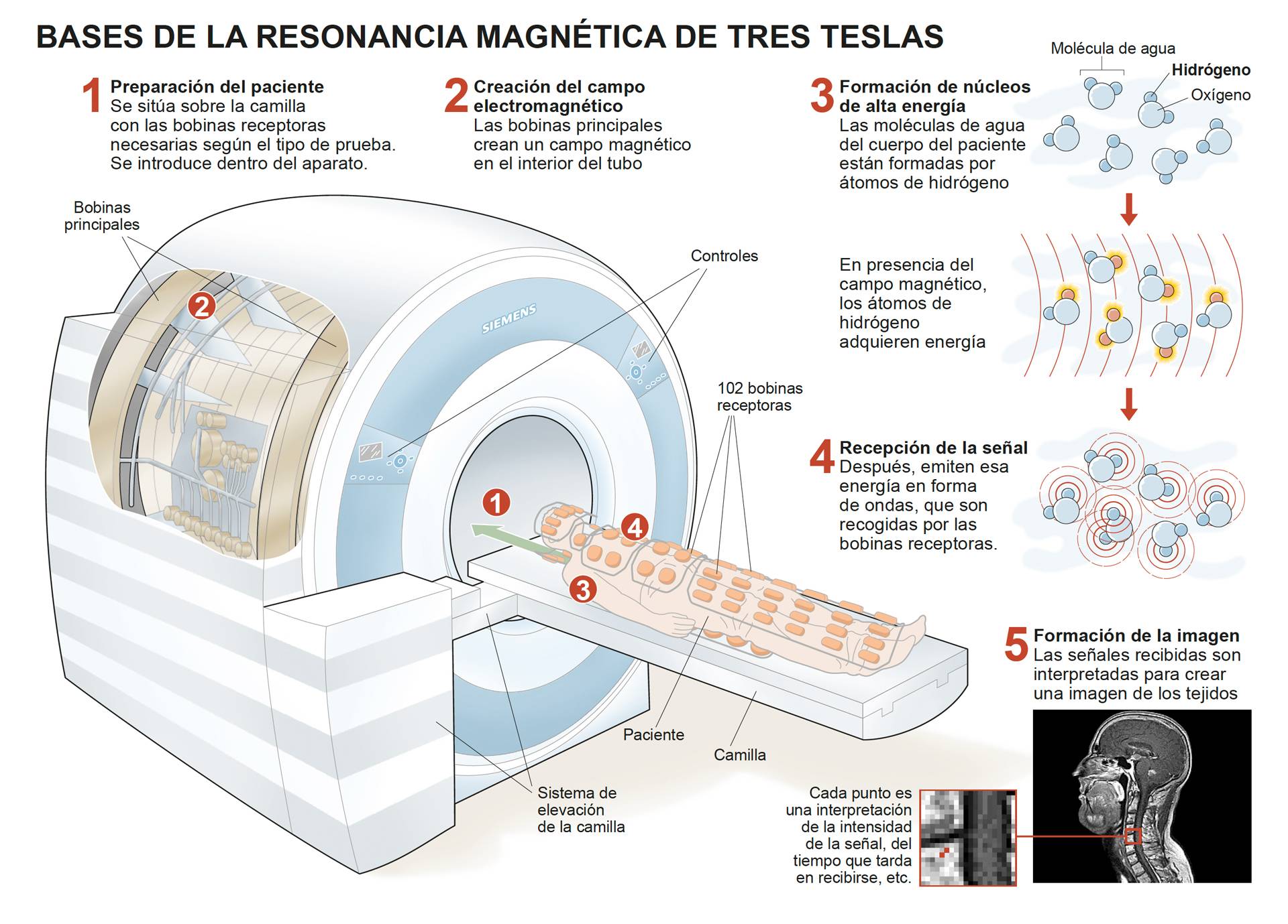 Como se hace una resonancia magnética de próstata