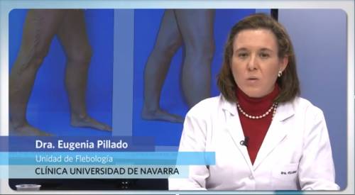 Tratamiento con microespuma de polidocanol para eliminar las varices En qué consiste el tratamiento de las varices con microespuma de polidocanol. Esta técnica eficaz y segura de escleroterapia permite tratar venas de cualquier tamaño incluso a aquellos pacientes que toman Sintrom. Es una técnica que permite tratar todos los segmentos venosos insuficientes, comenzado por su origen en las venas safenas o perforantes incompetentes y finalizando con las pequeñas ramas varicosas visibles en la piel.