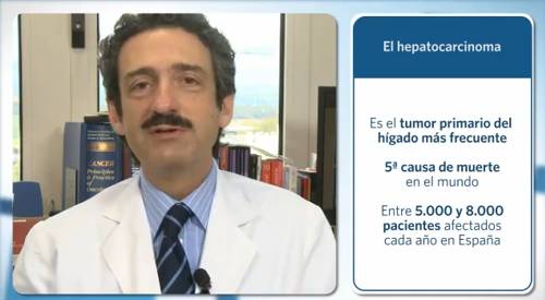 Últimas investigaciones en el cáncer de hígado (hepatocarcinoma) El Dr. Sangro habla sobre la incidencia del hepatocarcinoma y los tratamientos disponibles tanto quirúgicos como farmacológicos. Además de la terapéutica habitual, en la Clínica ofrecemos tratamientos innovadores como la aplicación de microesferas de Ytrio90 con excelentes resultados y se están desarrollando nuevas líneas de investigación que nos ayudarán a encontrar nuevas terapias para tratar este tipo de tumor.