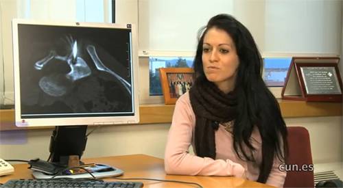 HistoriaCUN. Elisa osteoma osteoide Elisa Muñoz, paciente de la Clínica Universidad de Navarra, explica su experiencia tras ser diagnosticada y tratada de osteoma osteoide después de sufrir dos años de dolor.