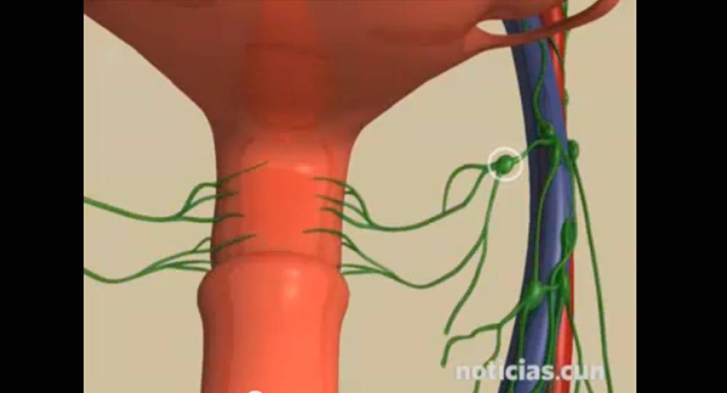 Ganglio Centinela Detectar la afectación del ganglio centinela permite mejorar el diagnóstico y el tratamiento en tumores de vulva, endometrio y cérvix. El ganglio centinela es el primer ganglio linfático que encuentran las células tumorales al intentar diseminarse a través de la linfa. Saber si está afectado o no con células tumorales variará el tratamiento para la enfermedad y se consigue un tratamiento personalizado, más preciso y más eficaz.