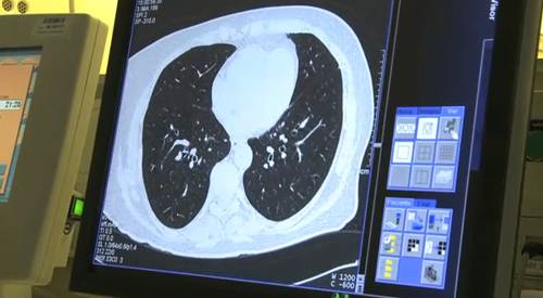 TAC preventivo anual, eficaz para detectar precozmente el cáncer de pulmón Realizar un TAC preventivo anual, es eficaz en la reducción de las muertes por cáncer de pulmón. La prevención es una estrategia eficaz frente al cáncer de pulmón ya que el pronóstico en estadios precoces, cuando puede resecarse todo el tumor y no hay invasión de ganglio, es muy bueno. En estos casos se puede conseguir la curación hasta en un 80% de los pacientes.
