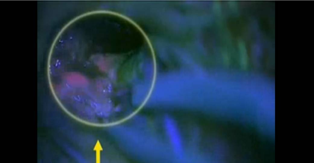 Microscopio fluorescente El uso del microscopio fluorescente consigue duplicar las extirpaciones completas de los tumores cerebrales malignos. Mediante una sustancia inoculada al paciente totalmente inocua, puede identificar completamente la zona tumoral y diferenciarla de la zona sana, consiguiendo una extirpación total del tumor en el 83% de los casos, frente al 30% que se lograba anteriormente.