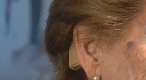 Recuperar la audición a los 80 años Beatriz recuperó la audición a los 80 años gracias a un implante coclear. Recomienda a todos aquellos que sufran problemas que prueben este tipo de dispositivo. La pérdida de audición o hipoacusia es un problema con una alta incidencia en la población general, desde la infancia hasta la ancianidad. Un gran número de las hipoacusias debidas a lesiones que afectan al oído medio son tratables con éxito mediante procedimientos conservadores o quirúrgicos, que, en algunos casos, pueden incluir la colocación de prótesis osteo-integradas o implantes de oído medio.