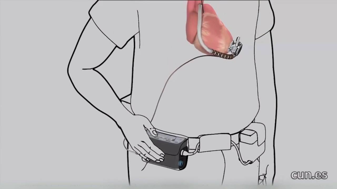 El orden alimenticio para luchar contra la obesidad El orden es un factor clave para una buena alimentación. El Dr. Javier Salvador explica cómo cuidar la dieta para luchar contra la obesidad. En la mayoría de los casos, la obesidad se produce por un aumento de la ingesta calórica, con frecuencia asociada a una actividad sedentaria. Una dieta correcta debe aportar la cantidad de calorías, proteínas, hidratos de carbono, lípidos, minerales, vitaminas, agua y fibra adecuados en función de la edad, el sexo, la etapa de desarrollo, la situación del organismo, etc.