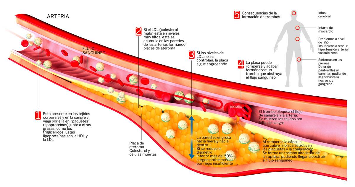 img-infografico-placa-ateroma