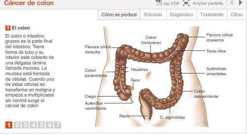 Imagen preview animación cáncer de colon. Área de Tumores de Tubo Digestivo