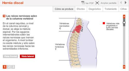 Imagen preview animación sobre hernia discal. Departamento de Cirugía Ortopédica y Traumatología.