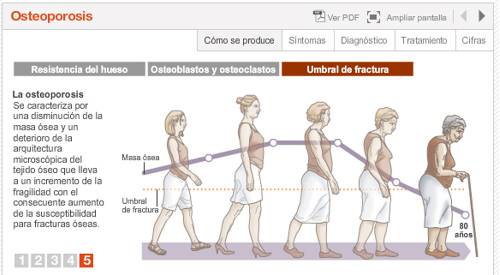 Imagen preview animación sobre la osteoporosis. Departamento de Endocrinología y Nutrición.