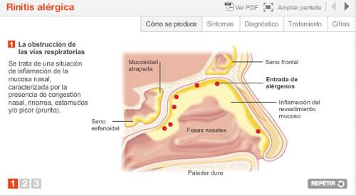 Imagen preview animación Rinitis alérgica. Departamento de Alergología