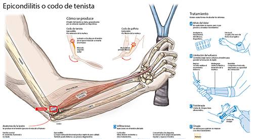 Imagen preview del infográfico sobre epicondilitis. Clínica Universidad de Navarra Imagen preview de la infografía sobre epicondilitis o codo de tenista, realizada por la Clínica Universidad de Navarra