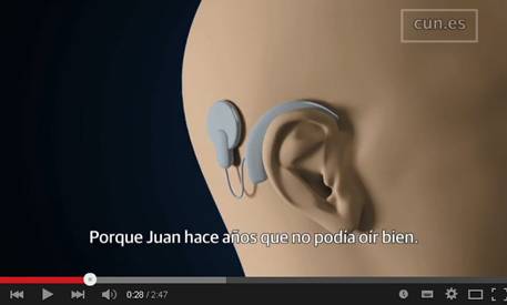 Implante coclear: qué es y cómo funciona Un implante coclear es un dispositivo electrónico que sustituye al oído externo, medio e interno, capaz de recoger los sonidos, transformarlos en estímulos eléctricos para transmitirlos al nervio auditivo y restablecer el flujo de información auditiva que llega al cerebro.